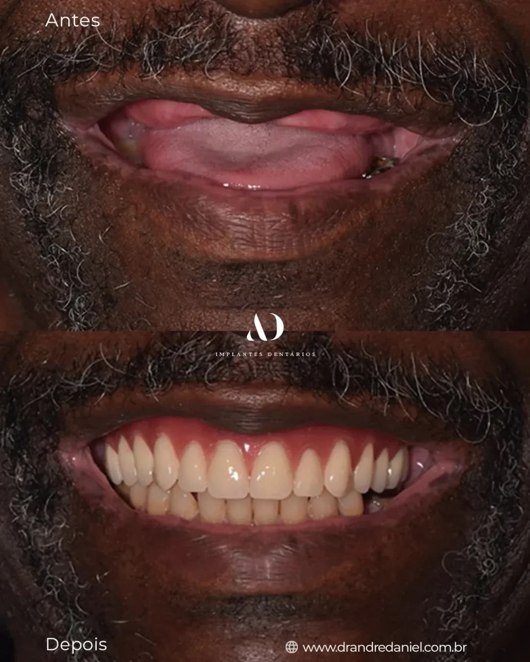 Reabilitação oral masculina com implantes dentários — antes e depois — Dr. André Daniel, Barra da Tijuca RJ