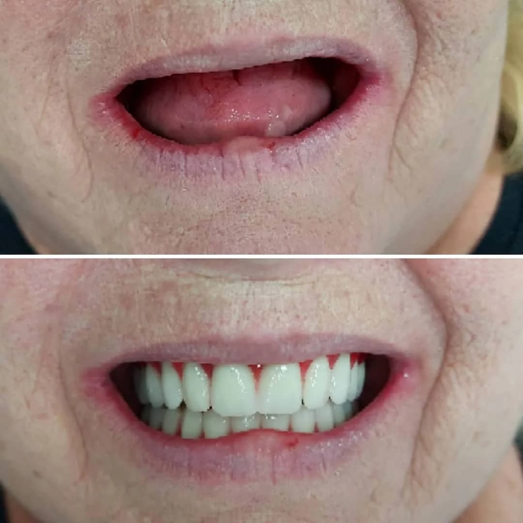 Reabilitação total em paciente edêntula — antes e depois com implantes dentários — Dr. André Daniel, Barra da Tijuca RJ