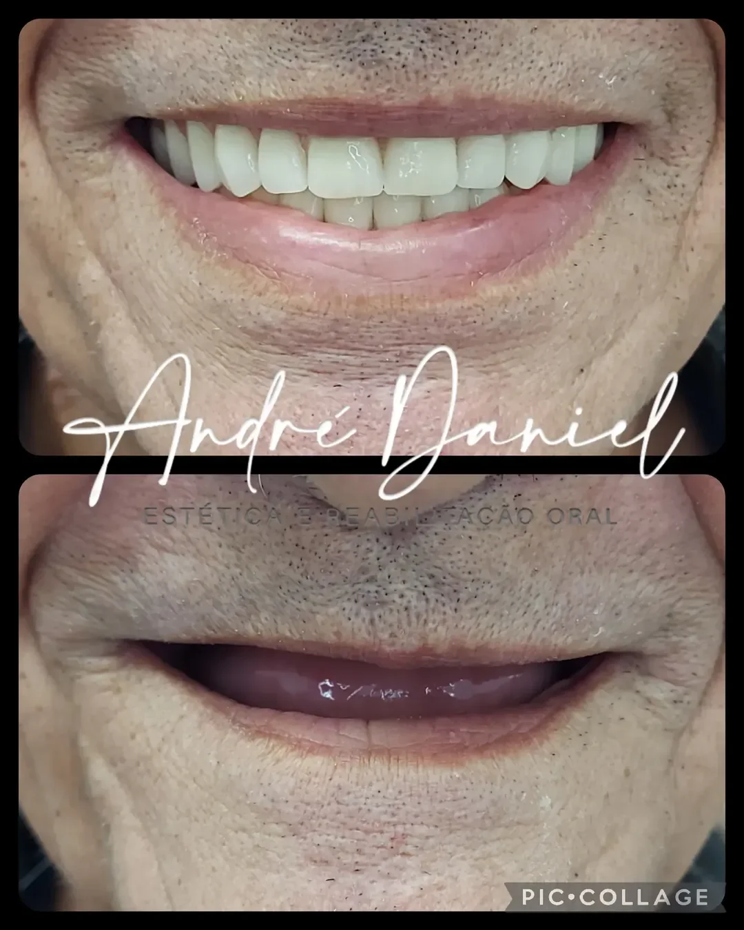 Reabilitação oral completa com prótese fixa — antes e depois — Dr. André Daniel, Barra da Tijuca RJ